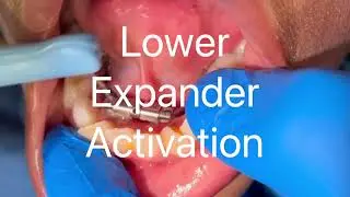 Lower Expander Activation