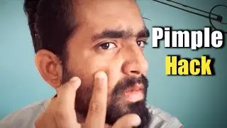Remove Pimple Naturally | Skin Care Routine in Tamil | Panu pi