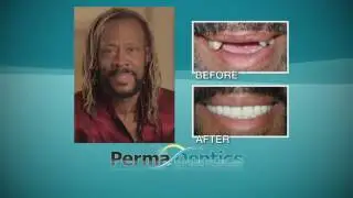 San Diego Teeth Implants