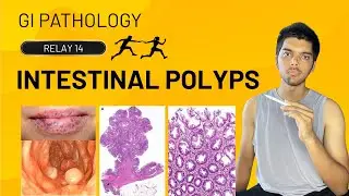 INTESTINAL POLYPS - GI Pathology 14 - Intestine - Complete Systemic Path Series