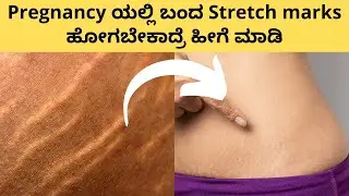 🤰🏻 Pregnancy ಯಲ್ಲಿ ಬಂದ Stretch marks ಹೋಗಬೇಕಾದ್ರೆ ಹೀಗೆ ಮಾಡಿ How to get rid of stretch marks Mylo Care
