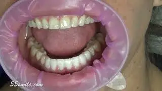 Prepless Upper and Lower Veneers Cosmetic Dentistry