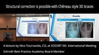 Structural correction is possible with Ch&ecirc;neau style 3D braces