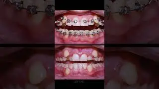 Braces process