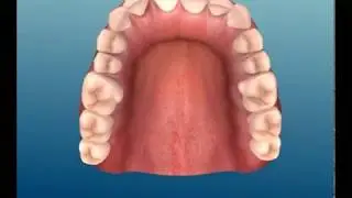 Invisalign Barcelona - Kieferorthop&auml;die - Deutscher Zahnarzt Barcelona