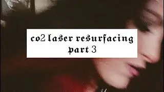 My Co2 Laser Resurfacing journey part 3