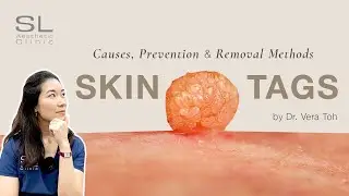 All about SKIN TAGS 👀 - Causes, Prevention & Removal #aesthetic #doctor #skincare #skintagremoval