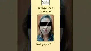 Buccal Fat Removal Before And After | Results After Surgery #shorts #buccalfatremoval #shortsfeed