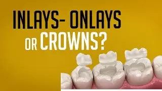 INLAY- ONLAY OR CROWNS? WHICH ONE IS BETTER FOR YOU?