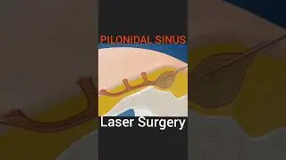 Pilonidal Sinus Laser Surgery #ytshorts