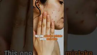 Why Vedalth Multani Mitti Soap Is Perfect for Acne #shorts