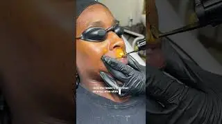 Pico laser treatment for lip pigmentation, a procedure that  laser technology to break down pigment