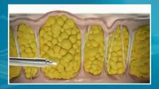 Cellulaze Laser Cellulite Reduction - Dr. Diktaban NYC Specialist