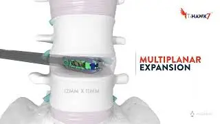 TiHawk7 FlareHawk Interbody Fusion System