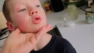 У Вовы ужасная аллергия