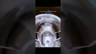 INTRA UTERINE DEVICE  REMOVAL.