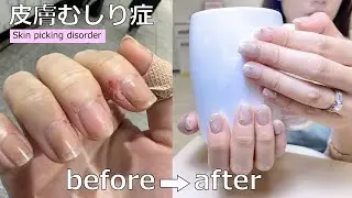 我如何治好摳皮症/皮膚撕除症/戒摳手皮｜皮膚むしり症を自力で治す方法