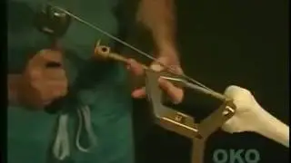 Rigid Retrograde Nailing of Femoral Shaft Fractures  Sawbone Demonstration