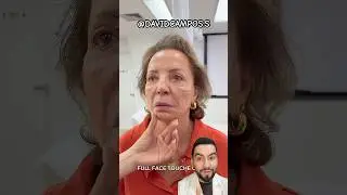 REJUVENECI&Oacute; SU ROSTRO CON &Aacute;CIDO HIALURONICO