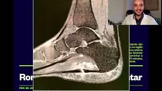 Ressonância magnética de rompimento de fáscia plantar