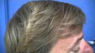 Dr Wong Hair Transplant Video - 4966 Grafts - 1 Session