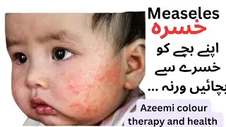 Measles خسرہ Sign and symptoms  Color Therapy Home Remedy