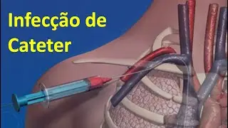 Infecção de Cateter