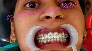 Smile correction of irregular place teeth