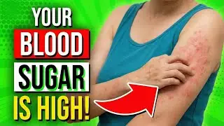 16 WARNING Signs Your BLOOD SUGAR Is HIGH & 8 Diabetes Symptoms