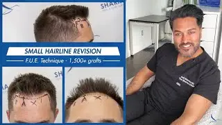 Small Hair Transplant - 1,500 grafts