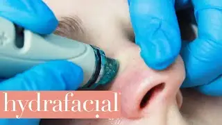 What is Hydrafacial Treatment? - The Red Carpet Facial