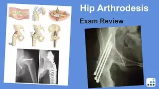 Hip Arthrodesis Exam Review - William Barrett, MD