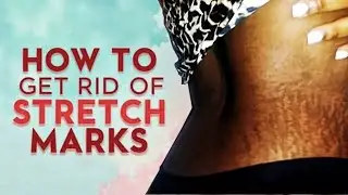 5 Powerful Ways to Remove Stretch Marks FAST | Get Smooth, Glowing Skin Naturally!