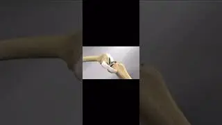 Persona System from Zimmer Biomet. Total Knee Replacement