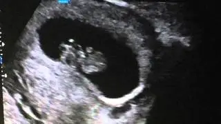 First Ultrasound