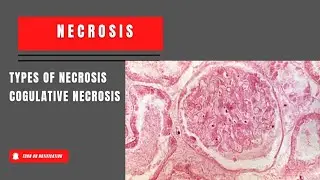 Types Of Necrosis|Cogulative Necrosis| #necrosistypes#coagulativenecrosis