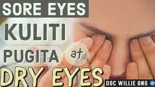 Sore Eyes, Kuliti, Pugita, Dry Eyes, Puwing sa Mata, Paglinis sa Mata - Payo ni Doc Willie Ong #173