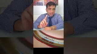 Leg Swelling Se Chhutkaara! | DVT Treatment Without Surgery