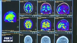 FDA approves new Alzheimer's drug | FOX 9 KMSP