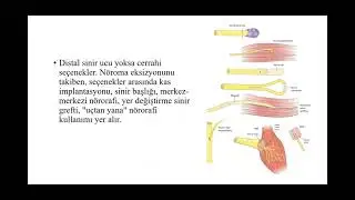 Nöroma sinir tümörü
