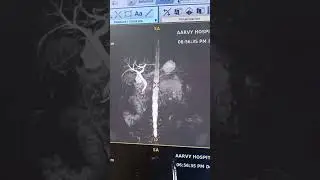 mri Mrcp 3D sinq