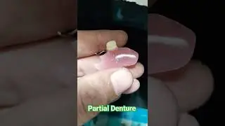 Single Unit Partial Denture By Haider #dentalartbyhaider #rpd #dentures #dentist