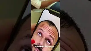Tratamento para rugas com toxina botul&iacute;nica em homens