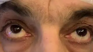 Downgaze palsy due to brain stem lesions