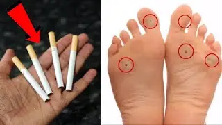 JUST 30 MINUTES  || How To Remove Foot Corn Or Callus At Home || MAGIC INGREDIENTS ||