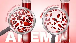Causes of Refractory Anaemia leading to Transfusional iron overload or siderosis