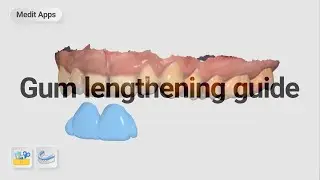 Designing a gum(crown) lengthening guide with Medit apps.