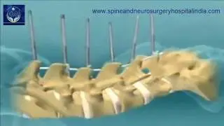 Low Cost Spinal Fusion Surgery in India | Affordable Spinal Fusion Surgery