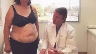 Tickle Liposuction of the abdomen