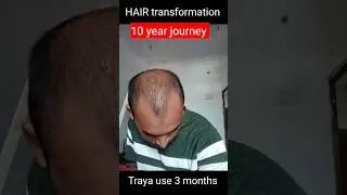 Traya 3month Result, Traya hair review | #shorts